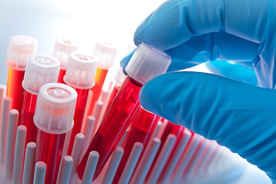 Hand with blood samples